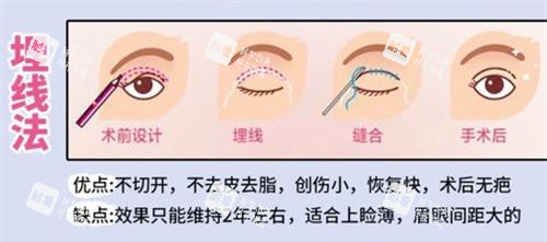 雙眼皮手術埋線法動畫演示圖