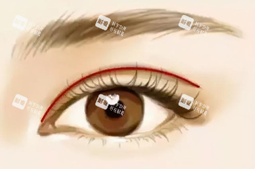 開扇形雙眼皮 開扇形雙眼皮