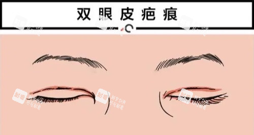 雙眼皮疤痕修復動畫圖