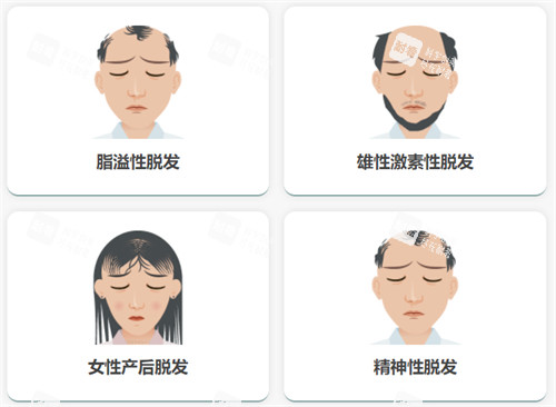 不同脫發(fā)類型