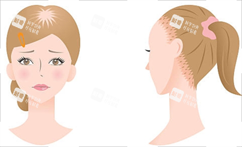 女生脫發(fā)類型