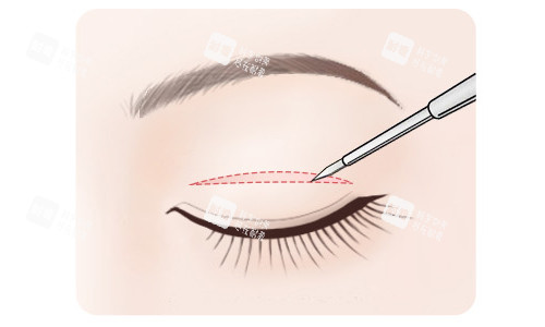 全切雙眼皮切口展示