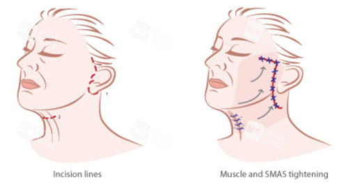 面部提升手術(shù)的對(duì)比和切口 面部提升手術(shù)的對(duì)比和切口