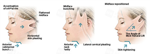 面部提升手術(shù)三種提升方向 面部提升手術(shù)三種提升方向