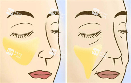 蘋果肌提升前后對(duì)比 蘋果肌提升前后對(duì)比