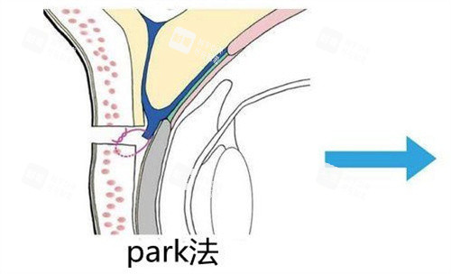 Park法雙眼皮