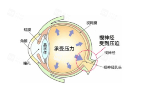 眼睛眼壓高概念圖 眼睛眼壓高概念圖