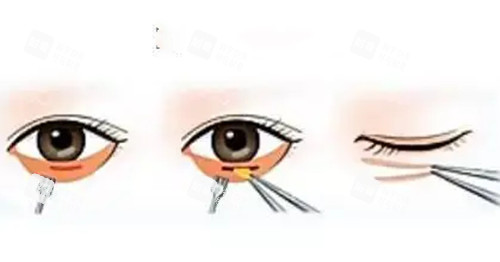 內(nèi)切法祛眼袋簡易步驟示意圖