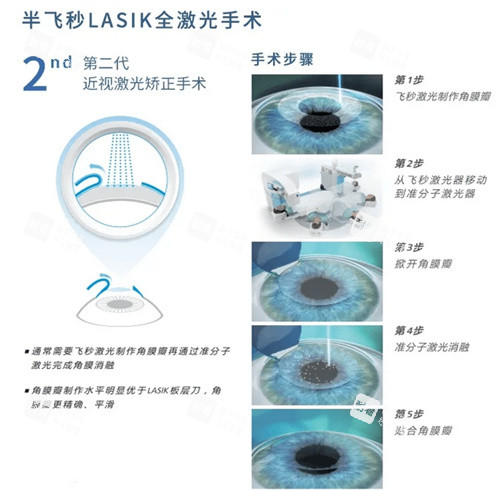 半飛秒手術(shù)示意圖 半飛秒手術(shù)示意圖