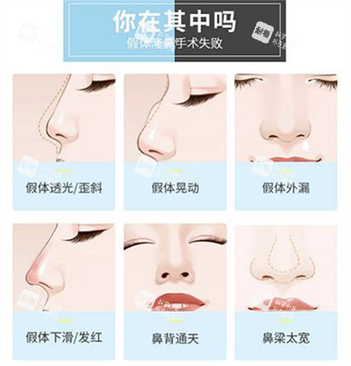 哪些鼻子需要做修復(fù)改善 哪些鼻子需要做修復(fù)改善