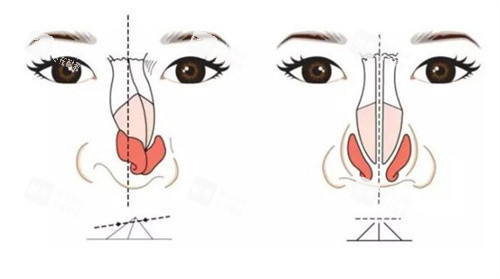 隆鼻修復(fù) 隆鼻修復(fù)