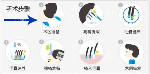 毛發(fā)移植手術步驟動畫演示圖