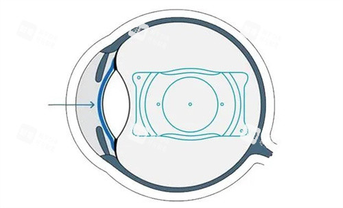 V4C晶體植入手術(shù)
