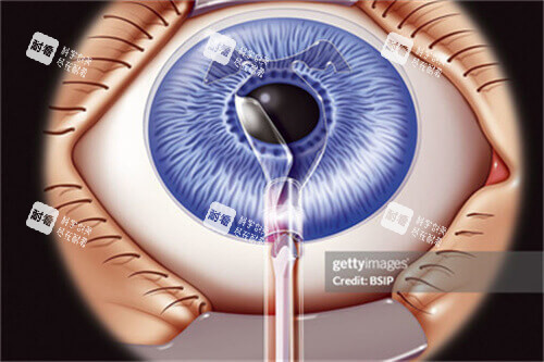 icl晶體植入手術(shù)