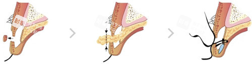 韓國bio整形眼部手術(shù)細(xì)節(jié)展示圖 韓國bio整形眼部手術(shù)細(xì)節(jié)展示圖