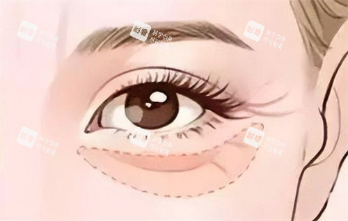 眼部填充膠原蛋白 眼部填充膠原蛋白