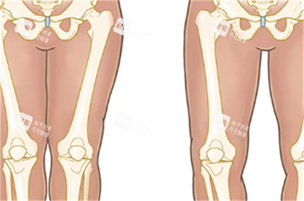 直腿術(shù)價(jià)格大揭秘!吸脂1.5萬起,脂肪移植2萬+,截骨矯形4萬+