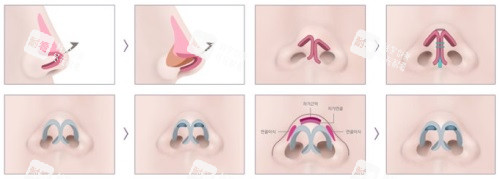 鼻修復(fù)示意圖