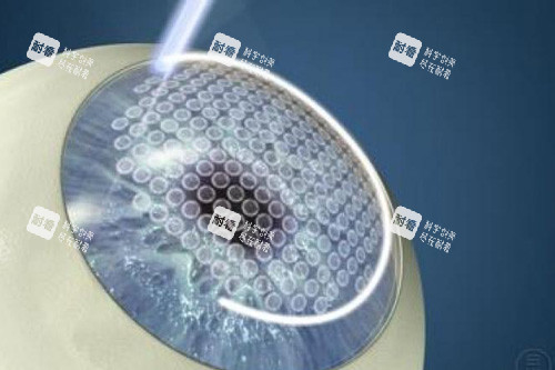 全飛秒近視手術(shù)示意圖 全飛秒近視手術(shù)示意圖