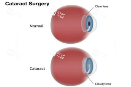 正常眼與白內(nèi)障眼對比 正常眼與白內(nèi)障眼對比