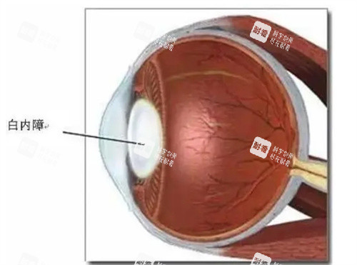治療白內(nèi)障 治療白內(nèi)障