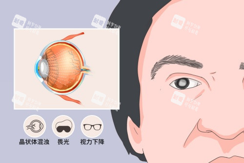 白內(nèi)障癥狀卡通一覽圖 白內(nèi)障癥狀卡通一覽圖