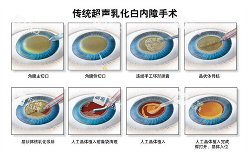 超聲乳化白內(nèi)障手術(shù) 超聲乳化白內(nèi)障手術(shù)