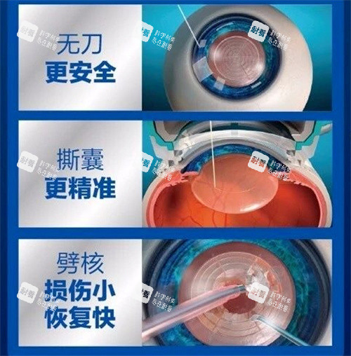 飛秒激光治療白內(nèi)障手術(shù)圖 飛秒激光治療白內(nèi)障手術(shù)圖