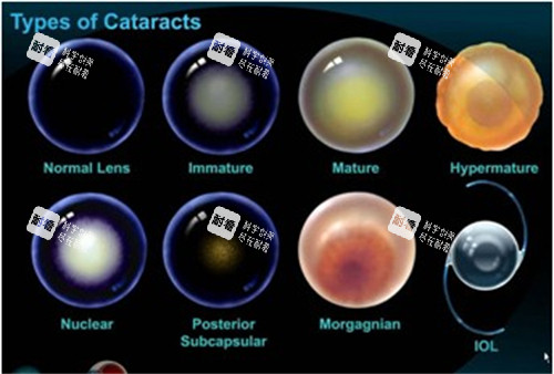 不同白內(nèi)障晶體展示 不同白內(nèi)障晶體展示