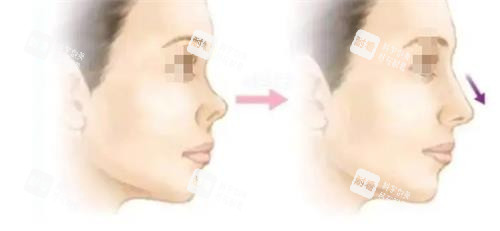 鼻翼緣后縮的癥狀 鼻翼緣后縮的癥狀