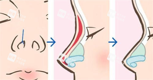 鼻部綜合隆鼻術(shù)前術(shù)后展示圖 鼻部綜合隆鼻術(shù)前術(shù)后展示圖