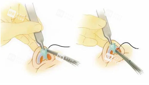 隆鼻手術(shù)鼻頭過(guò)程展示圖 隆鼻手術(shù)鼻頭過(guò)程展示圖