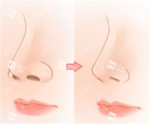 鼻翼縮小整形手術(shù) 鼻翼縮小整形手術(shù)