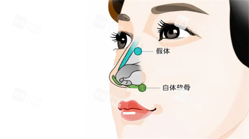 隆鼻卡通示圖 隆鼻卡通示圖