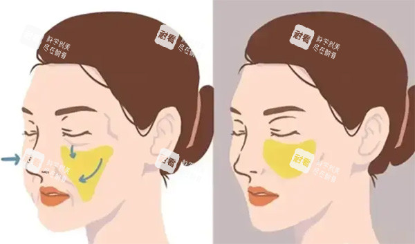 饅化臉脂肪移位照片 饅化臉脂肪移位照片