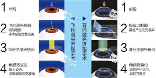 飛秒近視手術(shù)與激光近視手術(shù)的過(guò)程區(qū)別圖解 飛秒近視手術(shù)與激光近視手術(shù)的過(guò)程區(qū)別圖解