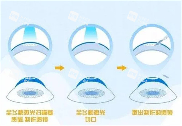 全飛秒激光眼睛照片 全飛秒激光眼睛照片