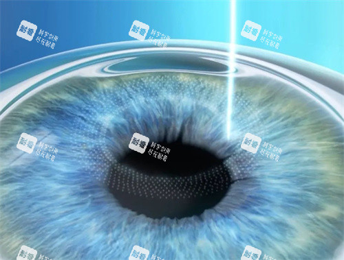 全激光近視手術(shù) 全激光近視手術(shù)