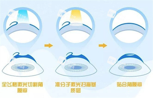 飛秒激光手術(shù)過程