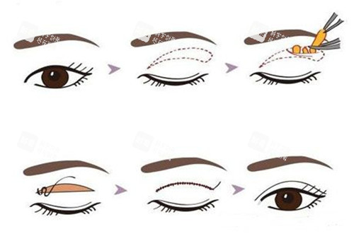 切開法眼部整形示意圖 切開法眼部整形示意圖