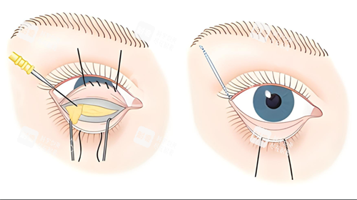 內(nèi)切祛眼袋圖