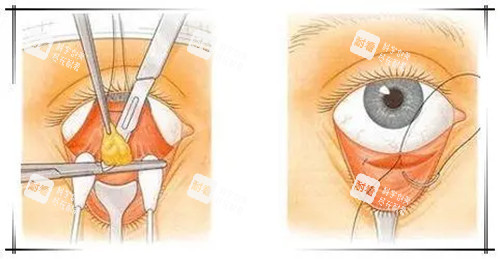 內(nèi)切法祛眼袋卡通示意圖