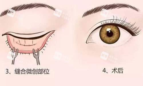 內(nèi)切祛眼袋展示圖