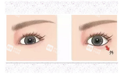 眼型矯正手術(shù) 眼型矯正手術(shù)