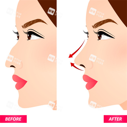 隆鼻手術(shù)改善鼻子角度 隆鼻手術(shù)改善鼻子角度