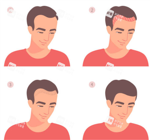 發(fā)際線植發(fā)前后圖解