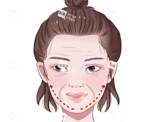 面部抗衰提升卡通圖 面部抗衰提升卡通圖