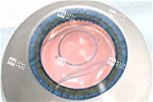 ICL晶體手術完成