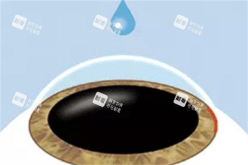 ICL晶體植入麻醉