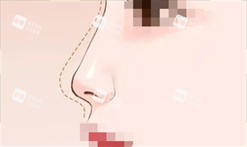 隆鼻預期弧度動畫呈現(xiàn)圖